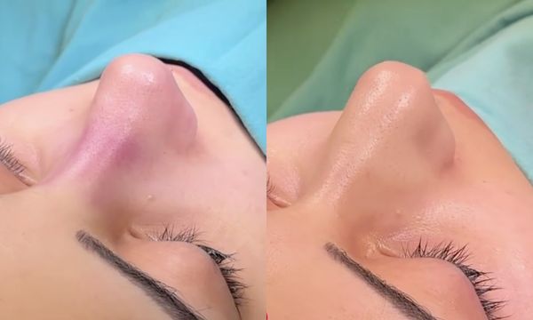 Rinoplastika nəticəsi